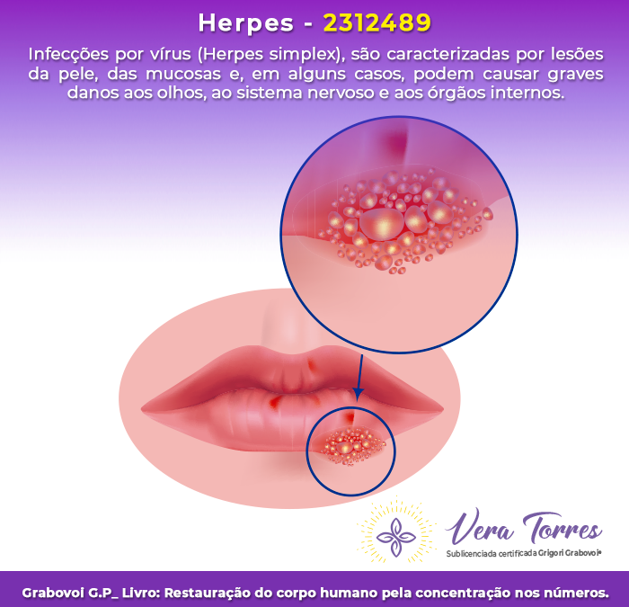 Herpes